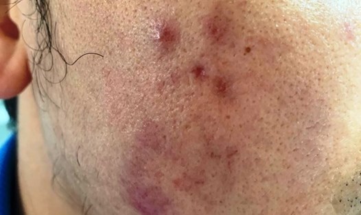 Da của một bệnh nhân bị nổi nốt sần đỏ do đi làm đẹp ở spa. Ảnh: Hiệp Phạm