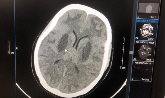 Hình ảnh tổn thương não của bệnh nhân Triệu Văn N. Ảnh: Bệnh viện Bạch Mai cung cấp