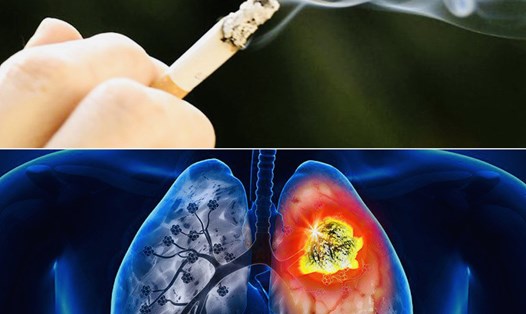 Nguyên nhân chính gây ra bệnh ung thư phổi là hút thuốc. Ảnh đồ họa: Hương Giang