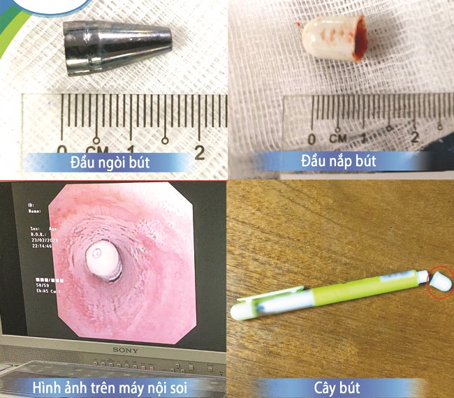 Hình ảnh dị vật là đầu ngòi bút và đầu nắp bút được gắp ra từ khí quản 2 bệnh nhi. Ảnh: Bệnh viện Nhi Trung ương cung cấp