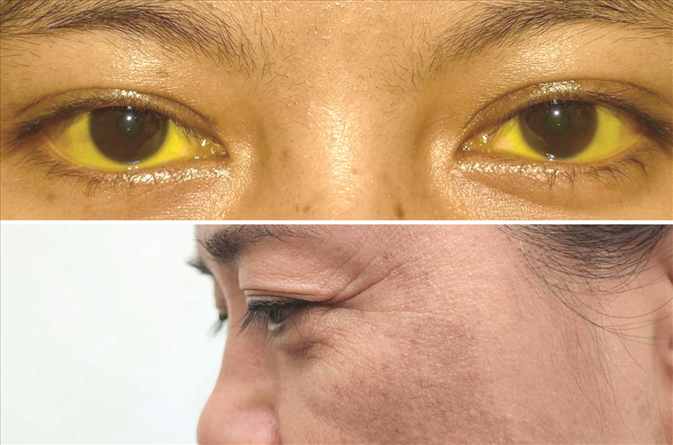 Vàng da kèm vàng mắt, sạm da là những dấu hiệu trên da cảnh báo bệnh xơ gan. Ảnh: Bệnh viện Đa khoa Tâm Anh TP Hồ Chí Minh