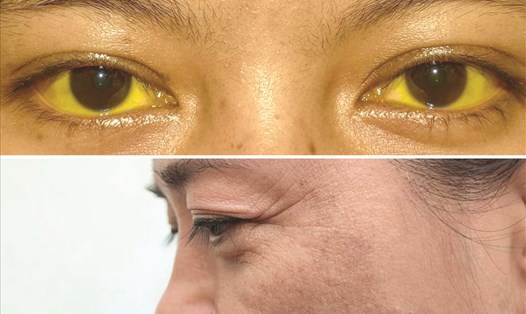 Vàng da kèm vàng mắt, sạm da là những dấu hiệu trên da cảnh báo bệnh xơ gan. Ảnh: Bệnh viện Đa khoa Tâm Anh TP Hồ Chí Minh