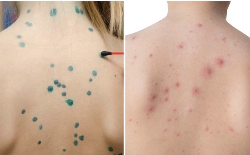 Bệnh thủy đậu và cách phòng ngừa hiệu quả