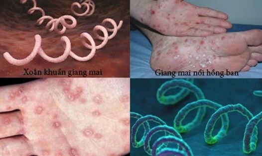 Xoắn khuẩn gây bệnh giang mai- một bệnh lây truyền qua đường tình dục phổ biến. Nguồn ảnh: Bệnh viện Phụ sản Hà Nội