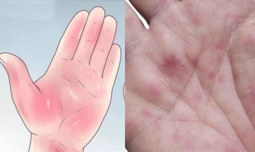 4 dấu hiệu ở lòng bàn tay cảnh báo về sức khỏe, có thể dấu ngầm của ung thư. Ảnh đồ họa: Tuệ Nhi
