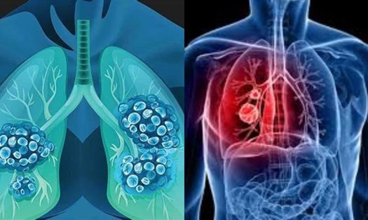 Phát hiện ung thư phổi sớm sẽ giúp điều trị kịp thời và kéo dài sự sống. Ảnh đồ họa: Tuệ Nhi