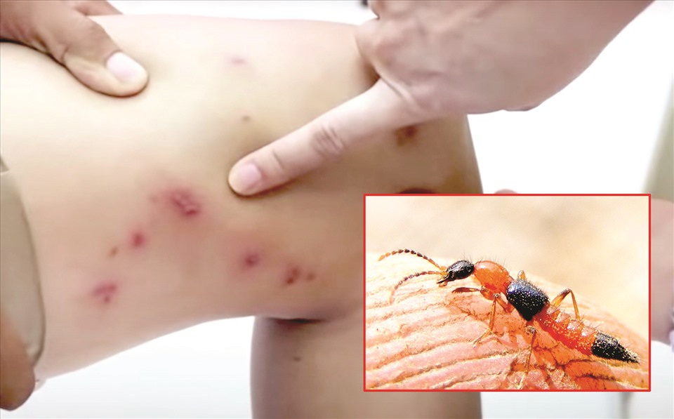 Vào mùa mưa, kiến ba khoang bắt đầu xuất hiện và gây hại cho sức khoẻ chúng ta. Đồ hoạ: Hạ Mây