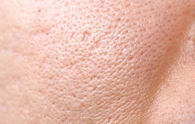 Không ít người gặp tình trạng lỗ chân lông to. Ảnh: Minh Hà