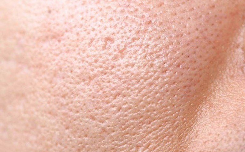 Da có lỗ chân lông to và bề mặt da thô ráp có thể được xử lý bằng Skinneedle