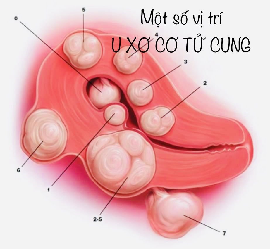 Phân loại u xơ cơ tử cung theo FIGO - Liên đoàn Phụ khoa và Sản khoa Quốc tế. Ảnh: Bệnh viện cung cấp