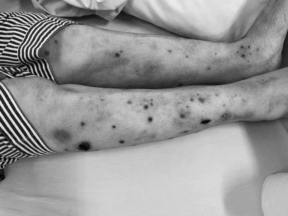 Vết ong châm trên cơ thể người bệnh. Ảnh: Bệnh viện cung cấp