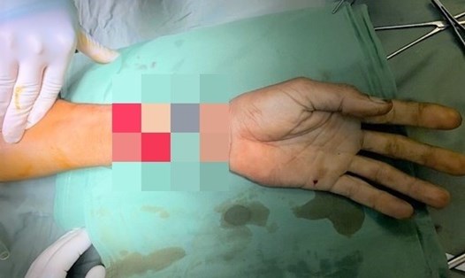 Bàn tay của nạn nhân sau phẫu thuật. Ảnh: Bệnh viện cung cấp.