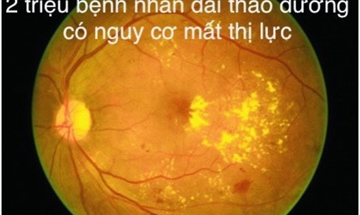 2 triệu bệnh nhân đái tháo đường có nguy cơ mất thị lực. Ảnh đồ họa: Hương Giang