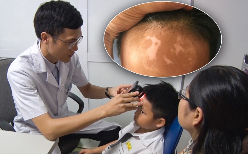  Bệnh viện Da liễu Trung ương áp dụng thành công phương pháp ghép tế bào thượng bì tự thân không qua nuôi cấy điều trị bệnh bạch biến. Ảnh: Phương Anh