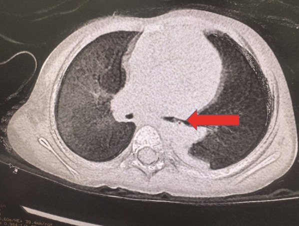 Hình ảnh CT scan phổi cho thấy dị vật ở phế quản thùy dưới phổi trái. Ảnh: Bệnh viện Nhi Đồng Thành phố