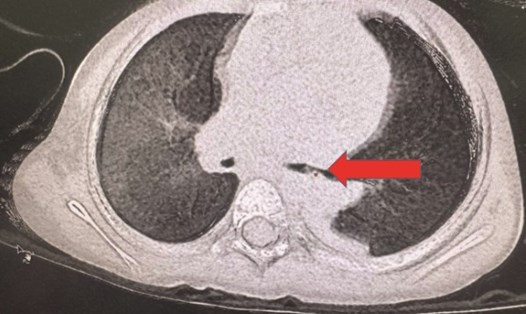 Hình ảnh CT scan phổi cho thấy dị vật ở phế quản thùy dưới phổi trái. Ảnh: Bệnh viện Nhi Đồng Thành phố