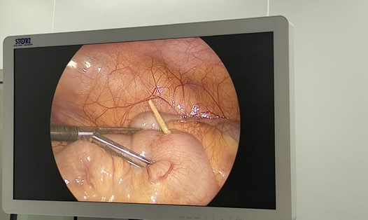 Hình ảnh dị vật tại hồi tràng ruột non của bệnh nhi. Ảnh: Bệnh viện quốc tế Sản Nhi Hải Phòng