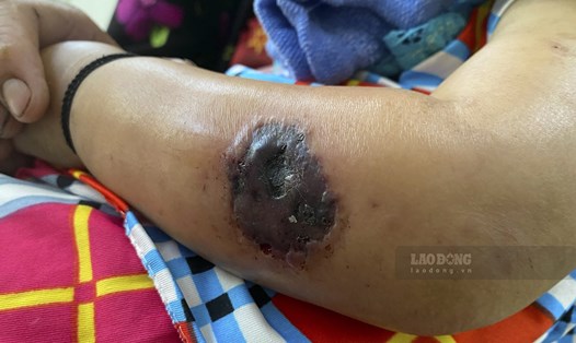 Bệnh nhân thứ 14 mắc bệnh than vừa được ghi nhận tại Điện Biên chỉ mới 2 tuổi. Ảnh: CDC Điện Biên