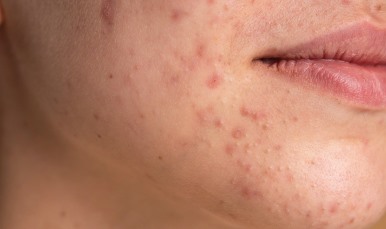 Da mụn vẫn cần dùng kem chống nắng nhưng phải biết cách. Ảnh: Hà Mi