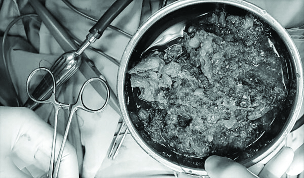 Khối bã thức ăn được giải phóng khỏi cơ thể của bệnh nhân. Ảnh: Bệnh viện Đa khoa tỉnh Phú Thọ