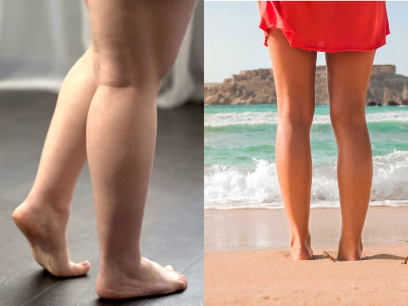 Nâng bóng là gì và cách thực hiện như thế nào để giảm mỡ bắp chân?

