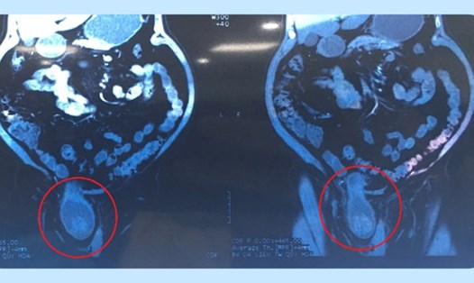 Hình ảnh thoát vị bàng quang (khoanh tròn đỏ) trên phim CT scan. Ảnh: Anh Thư