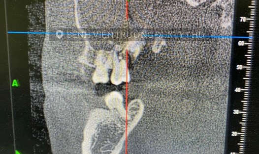 Bệnh nhân bị thủng xoang hàm sau khi nhổ răng số 8. Ảnh: Bệnh viện ĐH Kỹ thuật y tế Hải Dương