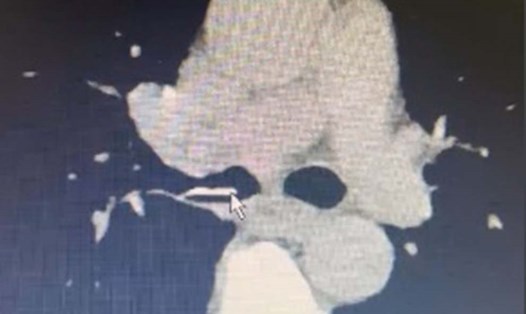 Trên phim chụp CT-Scanner, mảnh xương tại vị trí phế quản gốc phải của người bệnh. Ảnh: BV Việt Nam - Thụy Điển Uông Bí