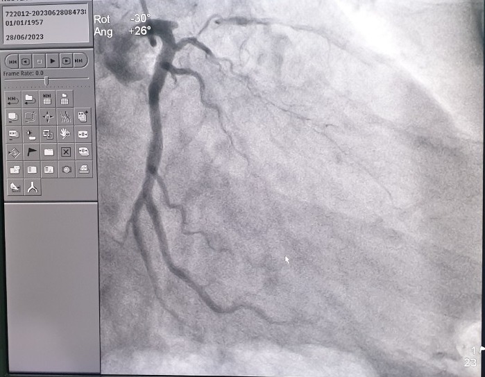  Gốc động mạch liên thất trước bị hẹp khít của bệnh nhân