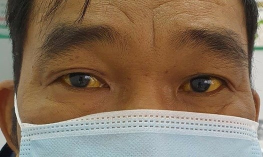 Người bệnh ở Phú Thọ bị vàng mắt, vàng da sau thời gian dài lạm dụng thuốc nam. Ảnh: Theo Sở Y tế tỉnh Phú Thọ