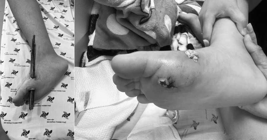 Trẻ L. P. N. 13 tuổi, nam, ngụ ở Long An, bị cây gỗ đâm xuyên qua bàn chân phải. Ảnh: Bệnh viện cung cấp