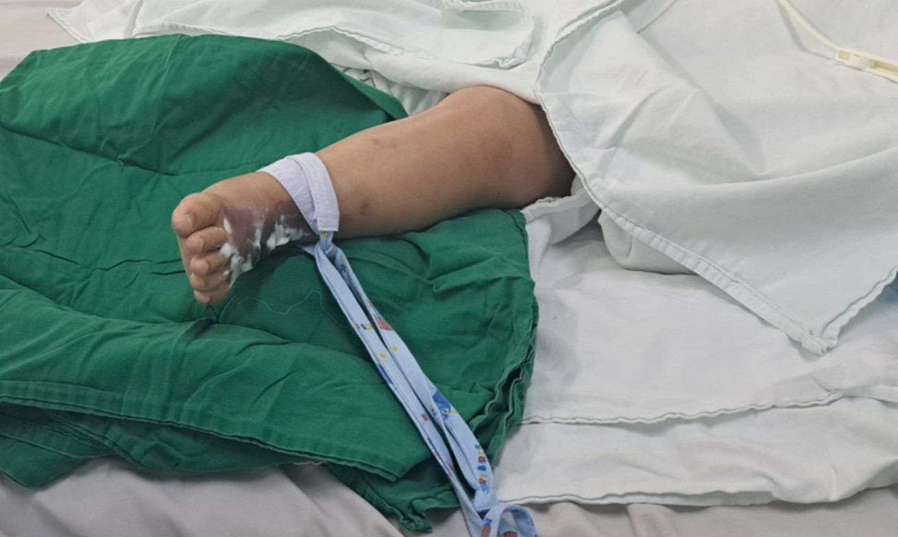 Bé trai 22 tháng tuổi bị rắn hổ mèo cắn ở chân. Ảnh: Bệnh viện cung cấp