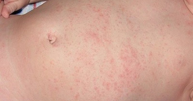 Bác sĩ cảnh báo tình trạng rôm sẩy ở trẻ những ngày nắng nóng