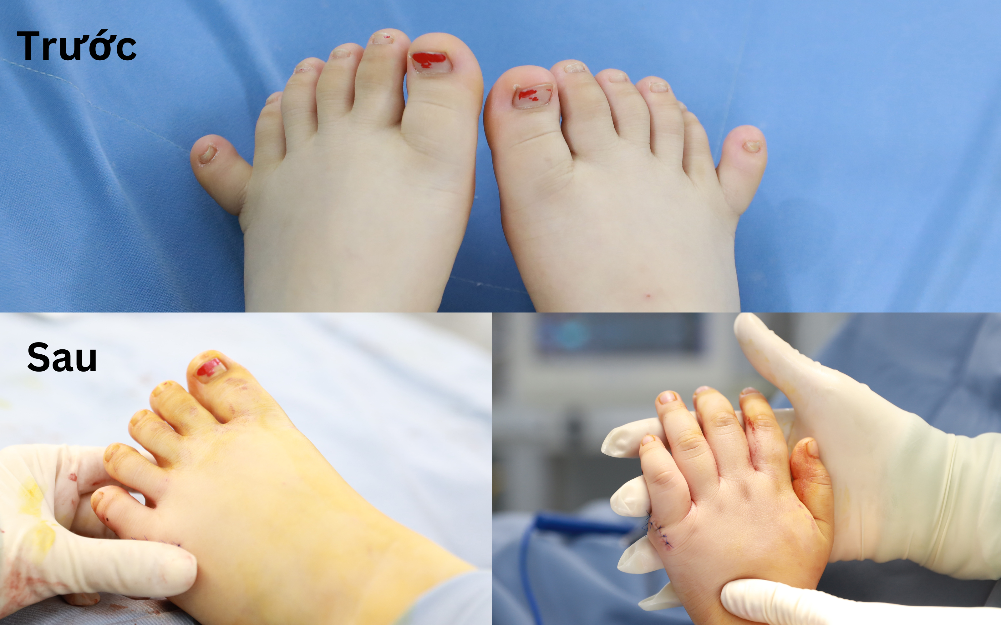 Hình ảnh hai bàn tay chân bị thừa ngón của T.L qua Xquang 