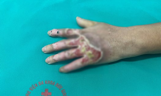 Tổn thương bỏng bàn tay bị nhiễm trùng do điều trị sai cách. Ảnh: BSCC
