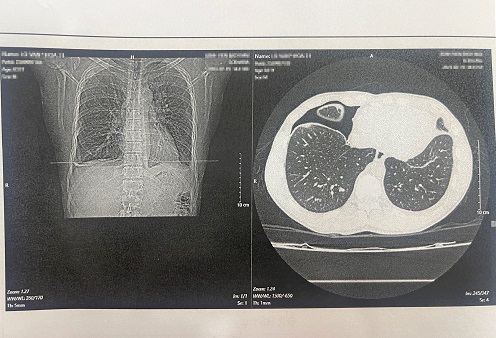 Hình ảnh phim chụp trên bệnh nhân nhiễm sán lá phổi. Ảnh: BVCC