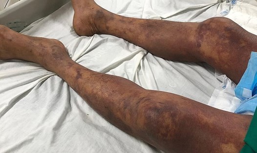Đôi chân bị xuất huyết hoại tử tím đen của bệnh nhân mắc bệnh liên cầu lợn. Ảnh: Bệnh viện cung cấp
