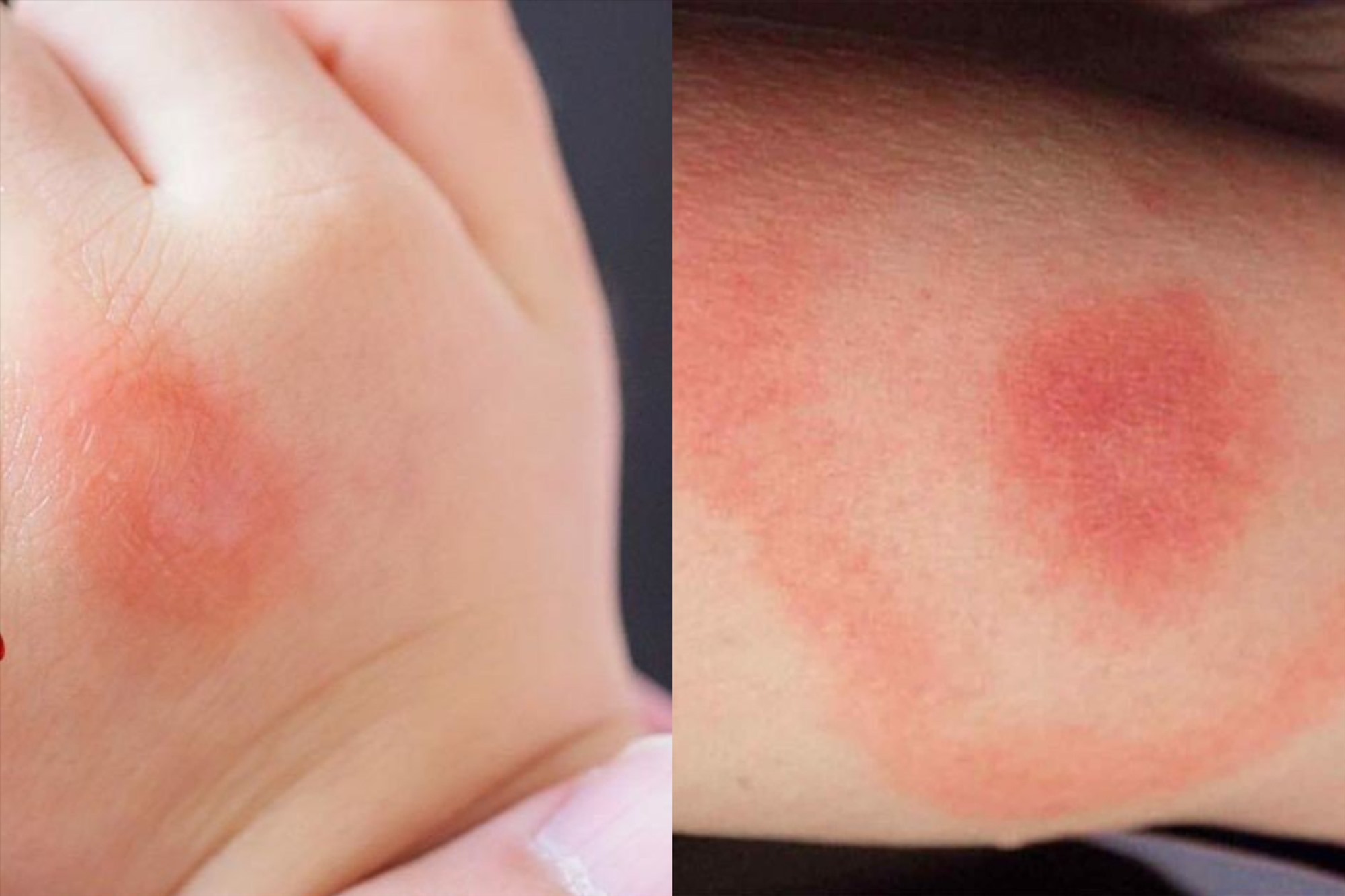 Cách để cha mẹ sơ cứu khi trẻ bị côn trùng đốt. Đồ họa: Thanh Thanh