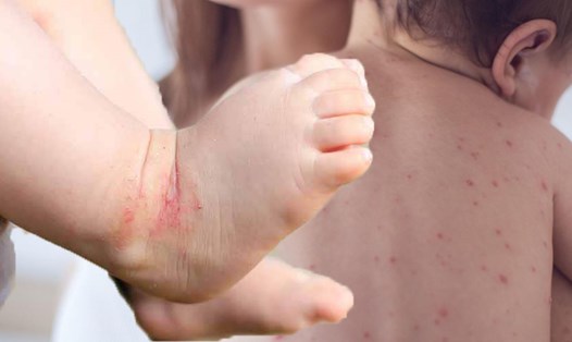 Trẻ sơ sinh dễ mắc các bệnh về da. Đồ hoạ: Hạ Mây