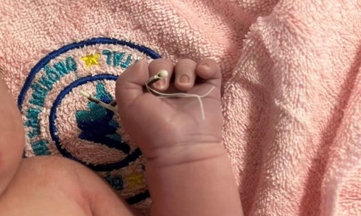 Em bé chào đời cùng với vòng tránh thai của mẹ. Ảnh: Khoa Sản, Bệnh viện Đại học Y dược TP HCM 