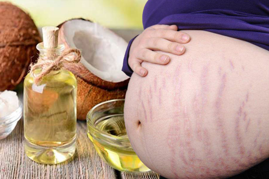 Những cách đánh bay vết rạn da theo cách tự nhiên
