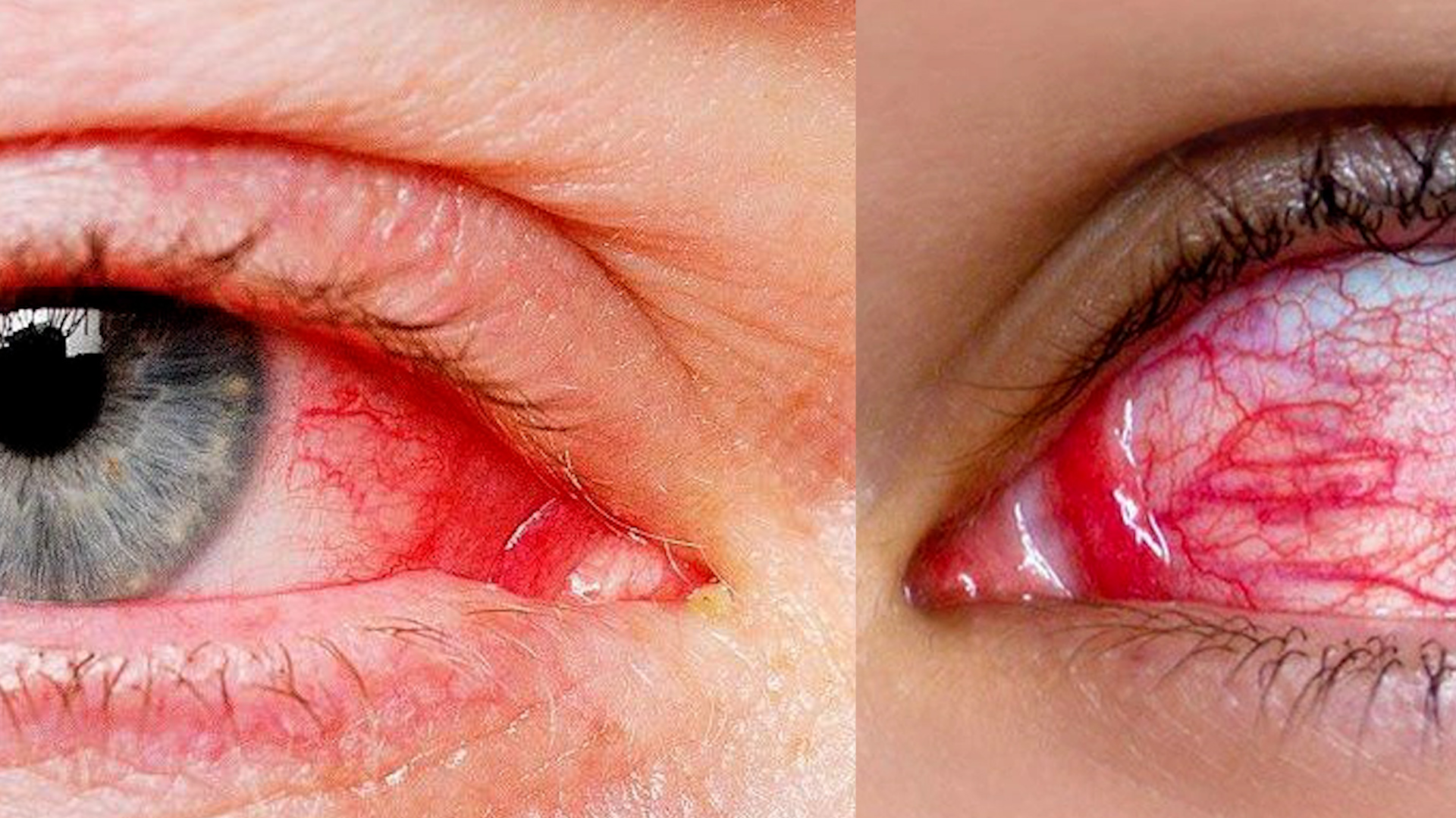 Hình ảnh đau mắt đỏ