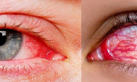 Bệnh đau mắt đỏ gây ra tình trạng nhiễm trùng mắt. Ảnh: NGUYỄN LY 