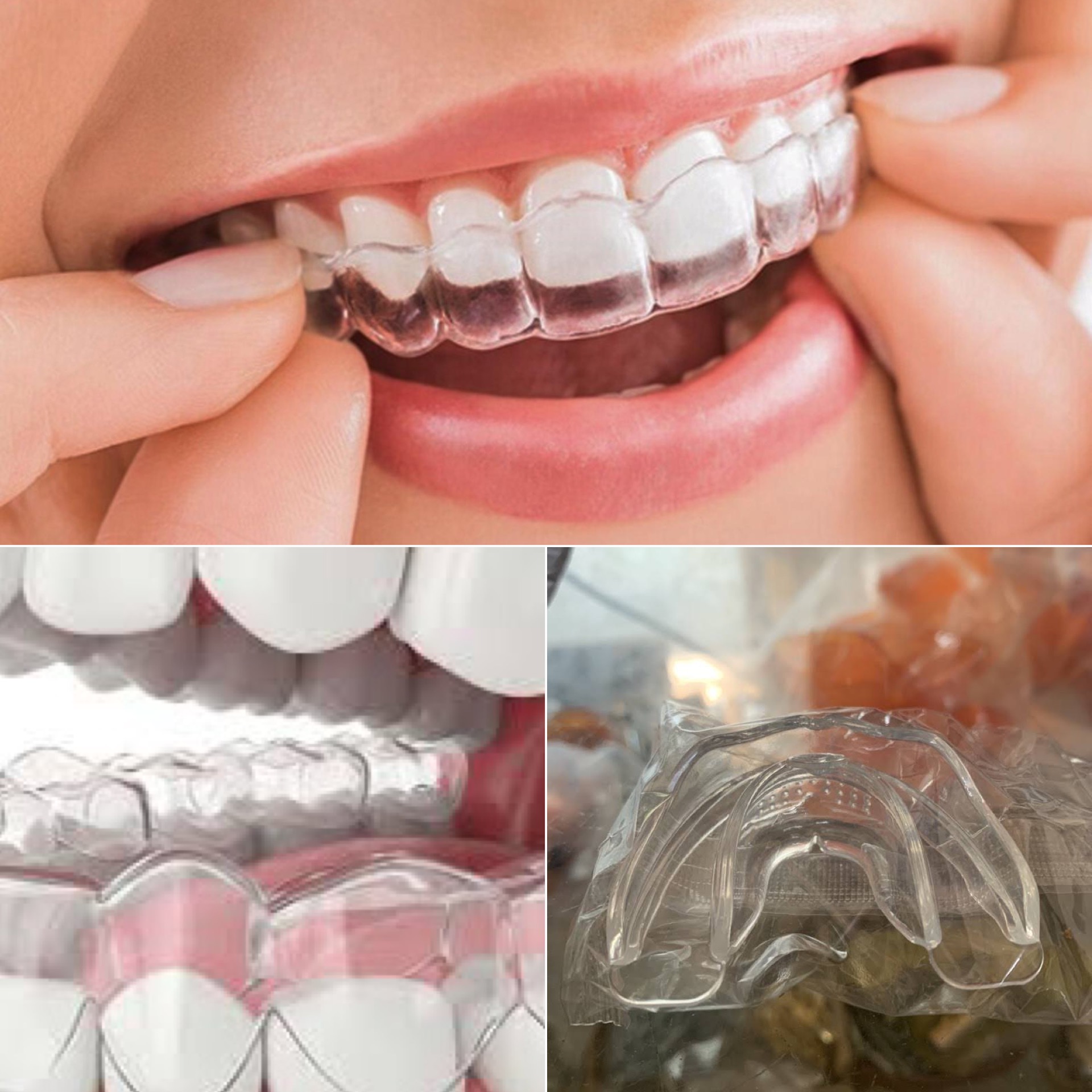 Niềng răng trong suốt có những ưu điểm vượt trội. Đồ hoạ: Hương Giang