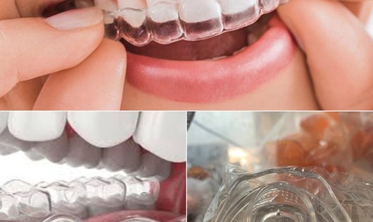 Niềng răng trong suốt có những ưu điểm vượt trội. Đồ hoạ: Hương Giang