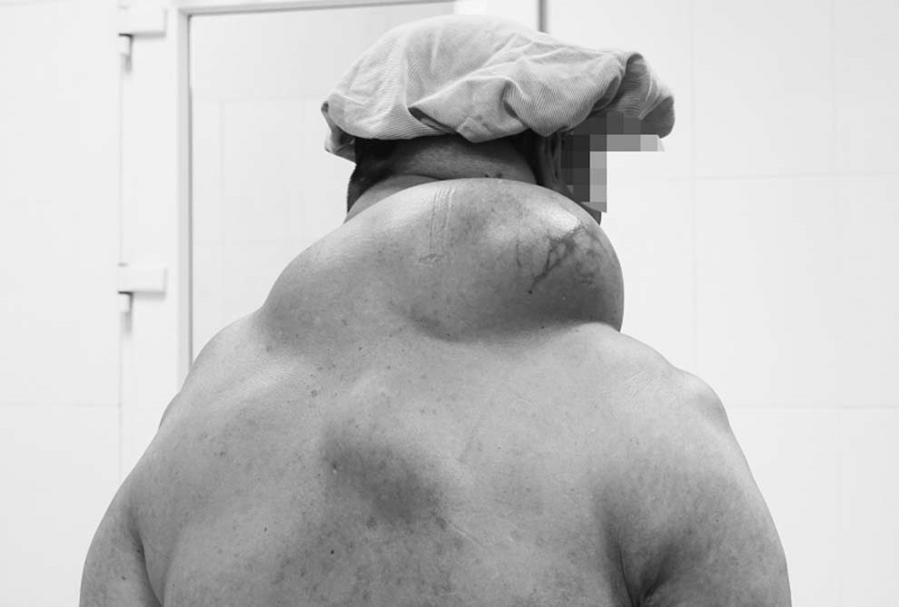 Giải phẫu khối u nặng gần 1,5 kg sau gáy bệnh nhân ở Quảng Ninh