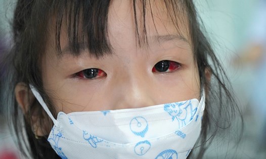Bệnh nhi đau mắt đỏ đi khám tại Bệnh viện Nhi đồng 2 TPHCM. Ảnh: CHÂN PHÚC 