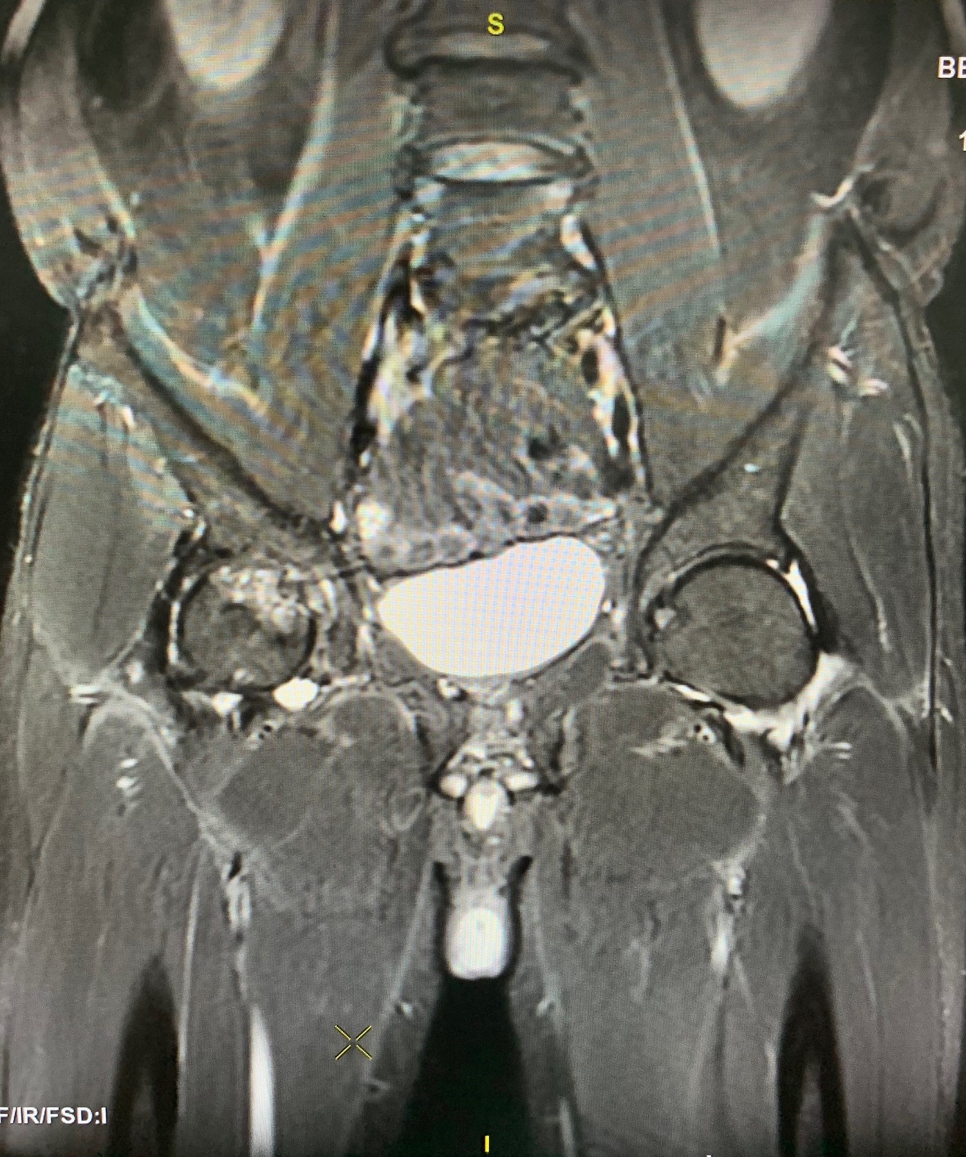 Hình ảnh chụp xương chậu của người bệnh. Ảnh: Bệnh viện cung cấp