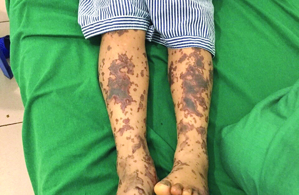 Người bệnh mắc liên cầu khuẩn lợn trên da có xuất huyết nhiều mảng thâm đen. Ảnh: Bệnh viện Trung ương Quân đội 108