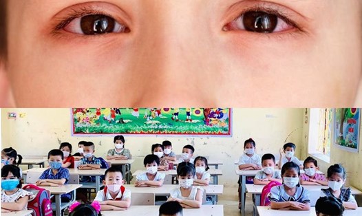 Các chuyên gia khuyến cáo học sinh bị đau mắt đỏ cần nghỉ học, tránh lây lan sang các bạn khác. Đồ họa: Hương Giang